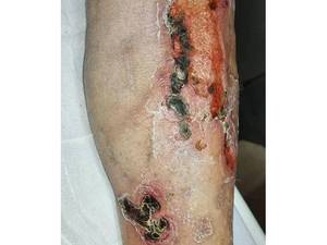 درمان زخم نوروایسکمیک دیابتی