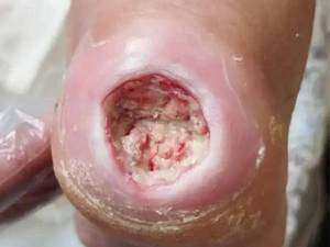 درمان زخم نوروایسکمیک دیابتی