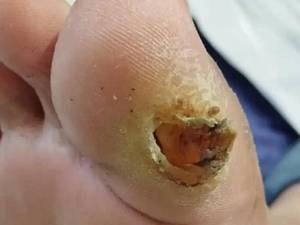 درمان زخم نوروپاتی دیابتی