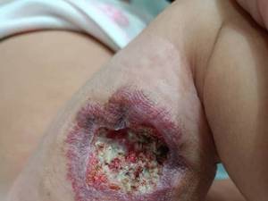 درمان زخم همانژیوم نوزاد 3 ماهه