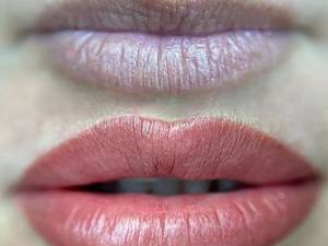 اصلاح فرم و قرینه‌سازی لب با شیدنیگ