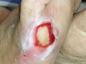 دکتر درمان زخم بستر در آمل