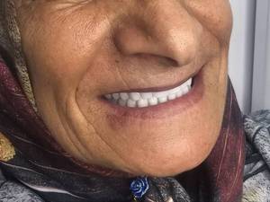 قیمت دندان مصنوعی کامل فک بالا و پایین در بوشهر