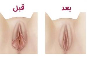 لابیا پلاستی با لیزر درلرستان