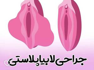 نوبت  بهترین دکتر لابیا پلاستی با لیزر درایلام