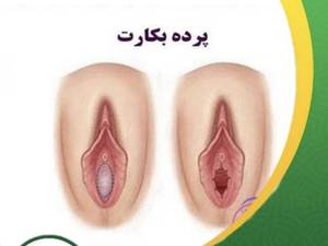 نوبت بهترین دکتر ترمیم معاینه پرده بکارت در الشتر لرستان