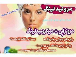 مزونیدلینگ