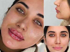 قیمت تزریق فیلر چانه در مشهد