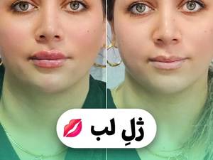 قیمت تزریق ژل لب در تهران