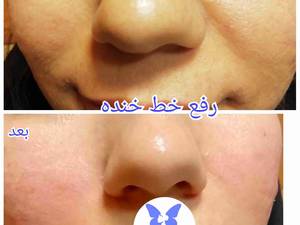 رفع خط خنده