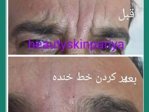 تزریق ژل خط اخم برای کاهش خطوط صورت
