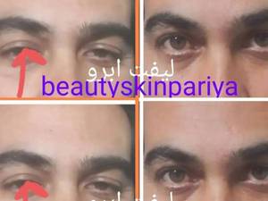 لیفت ابرو با نخ کلاژن‌ساز و فرم‌دهی طبیعی ابرو