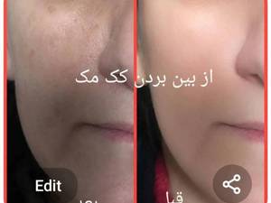 رفع لک و کک و مک با پلکسر