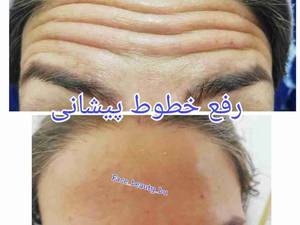 رفع خطوط پیشانی