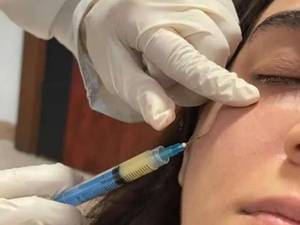 بایوفیلر برای جوانسازی و فرم‌دهی صورت