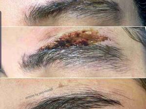 برداشتن تاتو ابرو در کرمانشاه