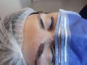 ریمو و پاک کردن تاتو ابرو در گیلان