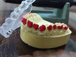 تری بلیچینگ حرفه ایی در اصفهان