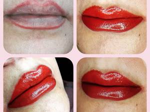 حجیم سازی لب روی لبی که خط لب تاتو شده