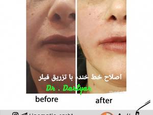 اصلاح خط خنده با فیلر