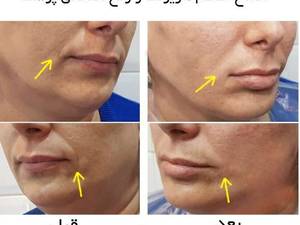 اصلاح خط غم ماریونت