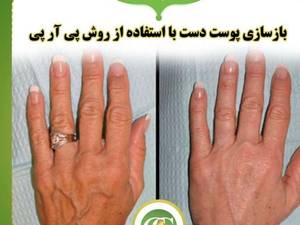پی آر پی