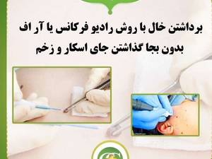 خال برداری