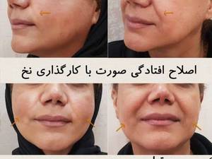 اصلاح افتادگی صورت