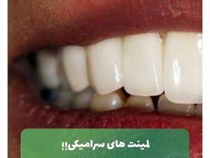 لمینت سرامیکی