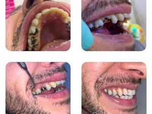 سازی و روکش دندان تخریب شده