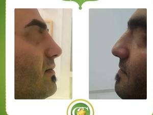 فرم دهی بینی